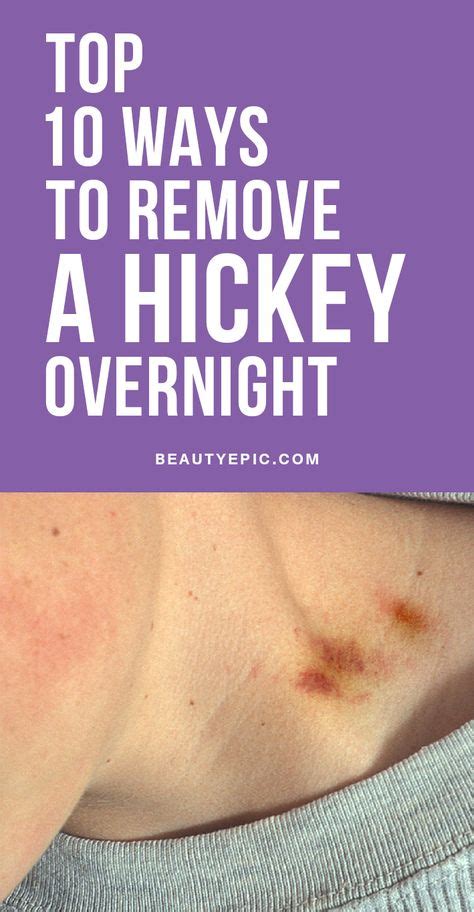 tit hickey|How To Get Rid of a Hickey: 5 Tricks To Try